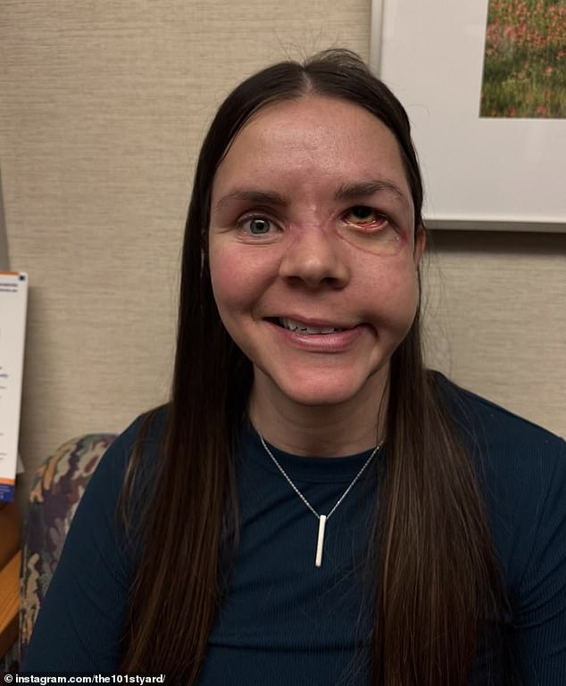 Kenai mother reveals devastating injuries eight months after grizzly bear mauling.